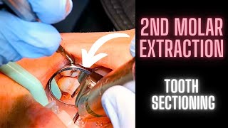 Surgical Extraction of a Maxillary 2nd Molar  Tooth Sectioning  OnlineExodontiacom [upl. by Constantia159]