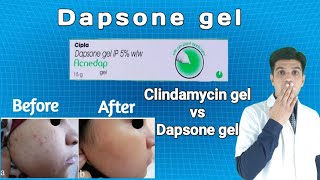 Dapsone gel  Dapsone gel for acne  Dapsone gel 5 ww [upl. by Marigolde]