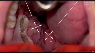 Grade 4 Tonsils with Dr Soroush Zaghi at The Breathe Institute  Pre and Post airway CBCT [upl. by Nykal]