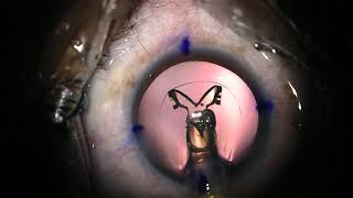 physiol toric trifocal IOL implantation [upl. by Dever]