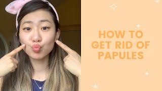 How to Get Rid of Papules  FaceTory [upl. by Heinrike]