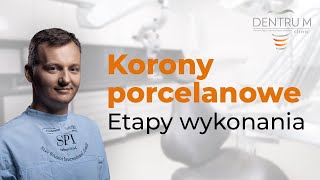 Korony porcelanowe etapy wykonania koron przez technika protetyka [upl. by Mascia]