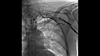 Left Upper Extremity Venogram of Thrombosis of Left Subclavian Vein With Network of Small Veins [upl. by Hama]