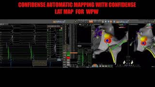 wpw ablation  AUTOMATIC MAPPING [upl. by Lenad708]