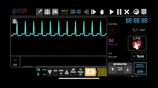 Supraventricular Tachycardia SVT Synchronised Cardioversion [upl. by Enilec]