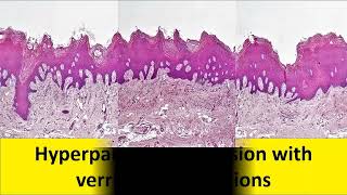 A Case of Proliferative Verrucous Leukoplakia [upl. by Macario]