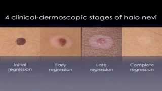 Halo Nevus  White Circles On Skin TREATMENT [upl. by Inaluahek]