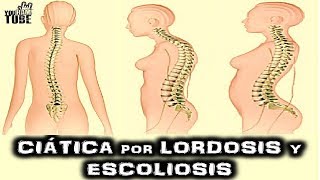 CIATICA DOLOR LORDOSIS Y ESCOLIOSIS TRATAMIENTO LA VERDAD [upl. by Carew]