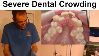 Severe Crowding of Teeth in Upper amp Lower Jaws by Dr Mike Mew [upl. by Dolphin]