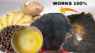 Results in one week Mix GINGER and CLOVES and your hair and baldness will grow 3 times unstoppable [upl. by Noletta]