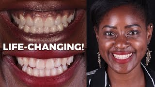 How I turned my black gums to pink Lifechanging Gum Depigmentation Experience [upl. by Llenrub]