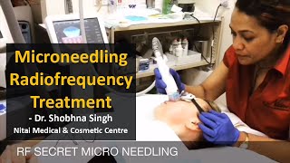 Microneedling RadiofrequencyRF Treatment  Secret RF  Nitai Cosmetics  Melbourne [upl. by Mastic566]