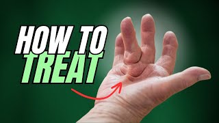 Dupuytrens Contracture Starts as Lump on Hand How to Treat [upl. by Ailedamla566]