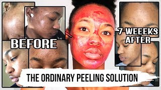 I LOOK LIKE THIS 7 WEEKS AFTER USING THE ORDINARY AHA 30  BHA 2 PEELING SOLUTION ♡OfficialTashika [upl. by Ceil366]