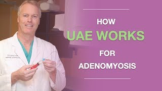 How Uterine Artery Embolization UAE Works for Adenomyosis [upl. by Ieppet]