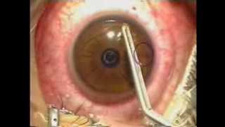 Lasik Laser Eye Surgery Procedure  Live Surgery [upl. by Llerahc]