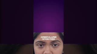 Demystifying Orbicularis Myokymia in 60 seconds Understand causes and discover treatment options [upl. by Ielak]