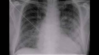 Chest xray Pulmonary edema lungs [upl. by Felder]