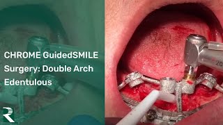 CHROME GuidedSMILE Edentulous Double Arch Surgery  CHROME Training Center Puebla [upl. by Olwen19]