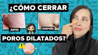 ¡ADIÓS POROS DILATADOS 👋🏻 Tips de una DERMATÓLOGA 👩🏻‍⚕️🤝🏻👌🏻 [upl. by Angelo]