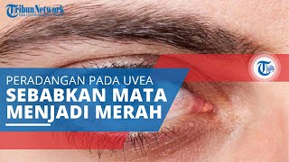 Uveitis Peradangan pada Uvea atau Lapisan Tengah Mata Ditandai Satu atau Kedua Mata Terlihat Merah [upl. by Mansfield295]