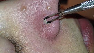 Pimple pop male nose [upl. by Searcy]