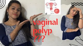 Vaginal polypampTreatment caues canceryoutubevideo health lifestyle girl [upl. by Adieren103]