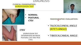 Congenital Talipes Equino Varus CTEV  Rapid Revision of Orthopaedics by Dr Prateek Joshi [upl. by Derag]