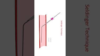 Seldinger Technique injection mbbs medicalsnippet Seldinger artery [upl. by Ennayehc626]