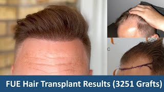 FUE Hair Transplant Results 3251 Grafts  105 Months Update  Dr Christian BISANGA  BHR Clinic [upl. by Ariait287]