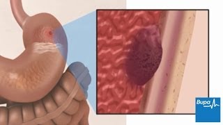 How a peptic ulcer develops  Bupa Health [upl. by Dichy]