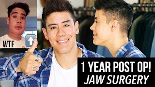 1 YEAR POST OP DOUBLE JAW SURGERY BEFORE amp AFTER FOOTAGE  JAIRWOO [upl. by Stedt]