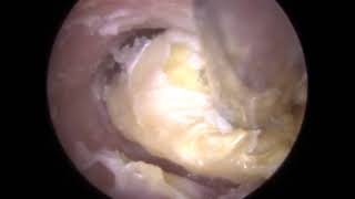 FUNGAL Ear Wax Removal Otomycosis in Otitis Externa Ear Canal  323 [upl. by Stover]