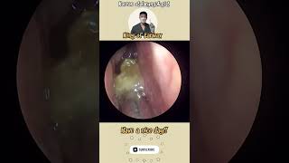 귀지형 콧물 부비동염 축농증 비염 코청소 이비인후과 rhinorrhea rhinitis sinusitis asmr ENT ENTdoctor [upl. by Ydnak]