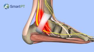 Tarsal Tunnel Syndrome [upl. by Ange909]