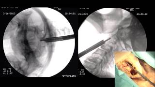 Odontoid Screw Fixation by Rick C Sasso MD [upl. by Sari]