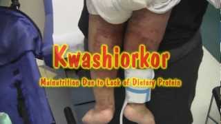 Kwashiorkor [upl. by Llenreb]