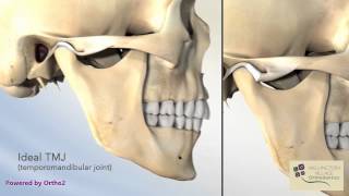 Closed Lock TMJ Lock Jaw  Wellington Village Orthodontics [upl. by Dole]