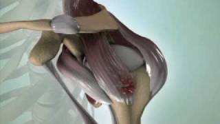 Torn Rotator Cuff Causes Symptoms amp Treatment  DePuy Videos [upl. by Blight523]