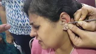 Auricular Therapy for Cervical Pain  Acupressure Natural Treatment for Cervical [upl. by Kcirdde]