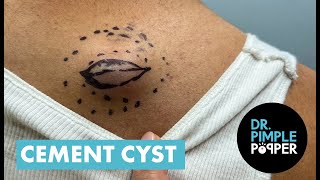 quotIts Like a Cement Truckquot  Dr Pimple Popper Removes The Cement Cyst [upl. by Elena]