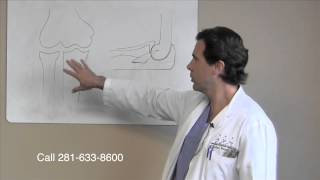 Posterolateral Elbow Instability  Orthopedic Surgeon Sugar Land Houston [upl. by Ellehcil]