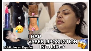 My Vaser Liposuction Journey  Maya Medical  Andrea Roman [upl. by Breskin]