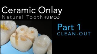 Lithium Disilicate Ceramics Part 1 Ceramic Onlay CleanOut 3 MOD [upl. by Westmoreland184]