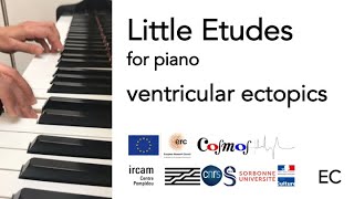 Little Etude Nº6 Ventricular Ectopics [upl. by Atinnod]