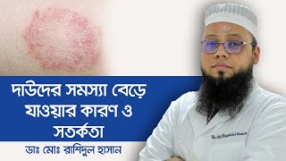 Ringworm Treatment Fungal Infection on Skin Symptoms Reason and Medicine for Ringworm Infection [upl. by Kessel957]