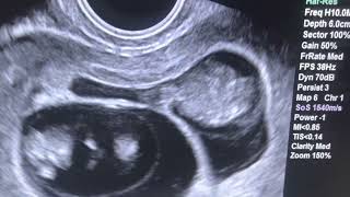 Ultrasound of Twin Pregnancy at 9 12 weeks [upl. by Ainegul]