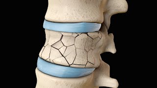 Back Surgery  Vertebroplasty and Kyphoplasty  Nucleus Health [upl. by Taite]