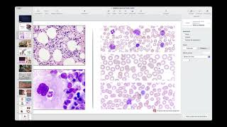 MÓDULO 6 SESION 1 DEL DIPLOMADO DE RESOLUCIÓN DE CASOS HEMATOLÓGICOS HEMOSTASIA NORMAL Y PATOL [upl. by Scrivenor]