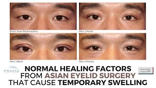 Normal Healing Factors of Asian Eyelid Surgery that Cause Temporary Swelling [upl. by Anneliese]